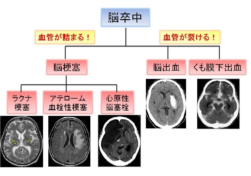 脳梗塞と抗血栓療法 川崎医科大学 木村和美教授 | 川村内科診療所様